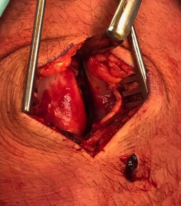 MPFL Patella Avusion